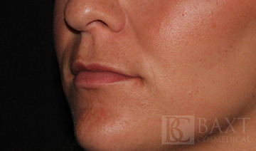 Fillers Before - Paramus, NJ Fillers Before - Paramus, NJ