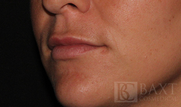 Fillers After - Paramus, NJ Fillers After - Paramus, NJ