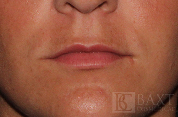 Fillers Before - Paramus, NJ Fillers Before - Paramus, NJ