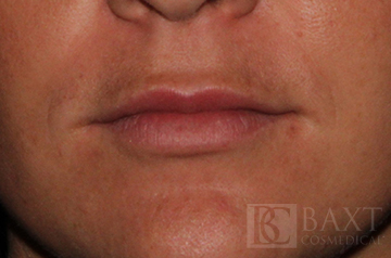 Fillers After - Paramus, NJ Fillers After - Paramus, NJ