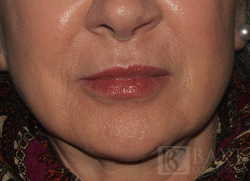 Fillers After - Paramus, NJ Fillers After - Paramus, NJ