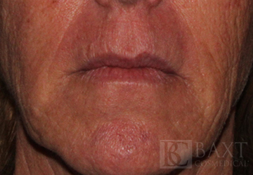Fillers Before - Paramus, NJ Fillers Before - Paramus, NJ