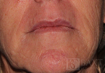 Fillers After - Paramus, NJ Fillers After - Paramus, NJ