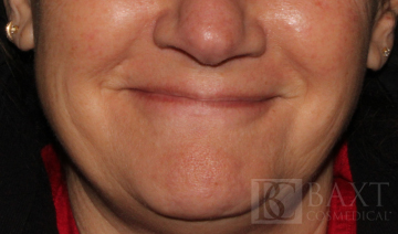 Fillers Before - Paramus, NJ Fillers Before - Paramus, NJ