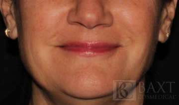 Fillers After - Paramus, NJ Fillers After - Paramus, NJ