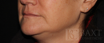 Fillers Before - Paramus, NJ Fillers Before - Paramus, NJ