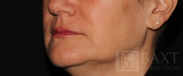 Fillers After - Paramus, NJ Fillers After - Paramus, NJ