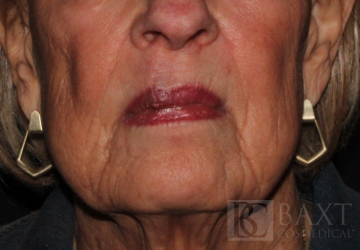 Fillers Before - Paramus, NJ Fillers Before - Paramus, NJ