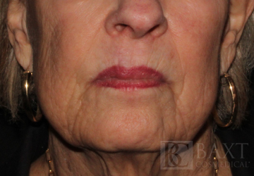 Fillers After - Paramus, NJ Fillers After - Paramus, NJ