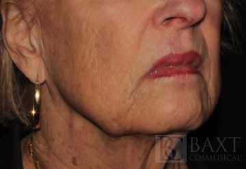 Fillers After - Paramus, NJ Fillers After - Paramus, NJ