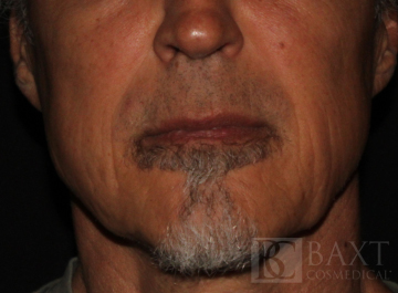 Fillers After - Paramus, NJ Fillers After - Paramus, NJ