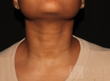 Fillers After - Paramus, NJ Fillers After - Paramus, NJ