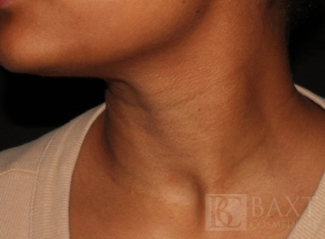 Fillers After - Paramus, NJ Fillers After - Paramus, NJ