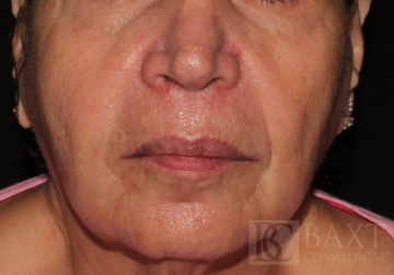 Fillers Before - Paramus, NJ Fillers Before - Paramus, NJ