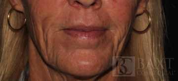 Fillers After - Paramus, NJ Fillers After - Paramus, NJ