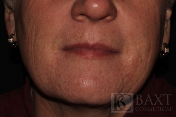 Fillers After - Paramus, NJ Fillers After - Paramus, NJ