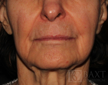 Fillers Before - Paramus, NJ Fillers Before - Paramus, NJ
