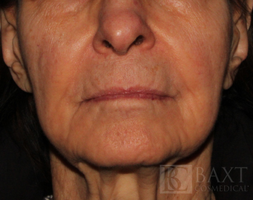 Fillers After - Paramus, NJ Fillers After - Paramus, NJ