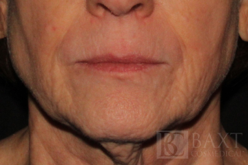 Fillers Before - Paramus, NJ Fillers Before - Paramus, NJ