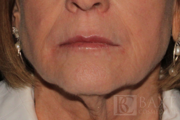 Fillers After - Paramus, NJ Fillers After - Paramus, NJ