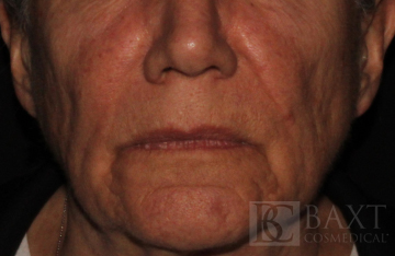 Fillers Before - Paramus, NJ