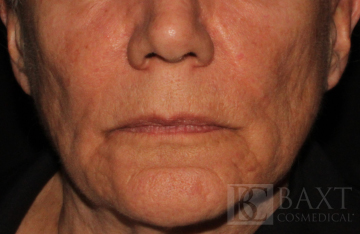 Fillers After - Paramus, NJ