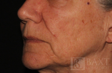 Fillers Before - Paramus, NJ