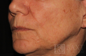 Fillers After - Paramus, NJ