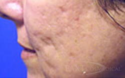 Fraxel® Before - Paramus, NJ