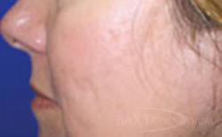 Fraxel® After - Paramus, NJ