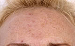 Fraxel® Before - Paramus, NJ