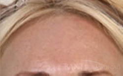 Fraxel® After - Paramus, NJ