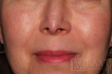Fraxel® After - Paramus, NJ Fraxel® After - Paramus, NJ