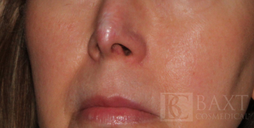Fraxel® Before - Paramus, NJ Fraxel® Before - Paramus, NJ