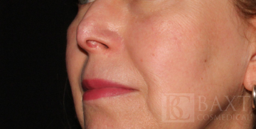 Fraxel® After - Paramus, NJ Fraxel® After - Paramus, NJ