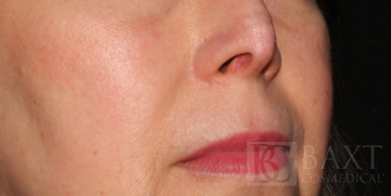 Fraxel® After - Paramus, NJ Fraxel® After - Paramus, NJ