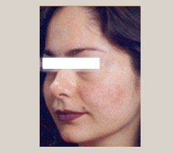 Isolaz® After - Paramus, NJ Isolaz® After - Paramus, NJ