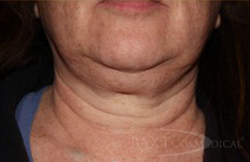 Fillers Before - Paramus, NJ Kybella™ Before - Paramus, NJ