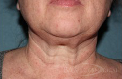 Fillers After - Paramus, NJ Kybella™ After - Paramus, NJ