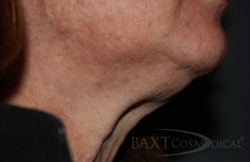Closeup of patient after KYBELLA® Treatment