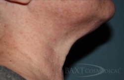 Kybella™ Neck Treatment - After - Paramus, NJ Kybella™ After - Paramus, NJ