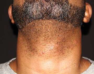 Before Hair Removal Closeup of male patient with neck stubble before hair removal