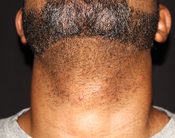 Closeup of male patient with neck stubble before hair removal