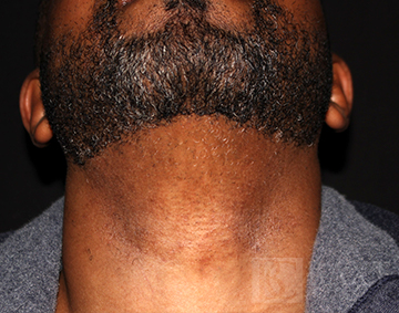 Closeup of male patient after hair removal