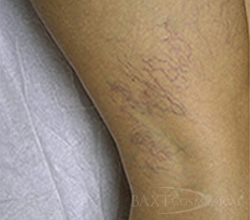 Leg Vein Treatment Before - Paramus, NJ