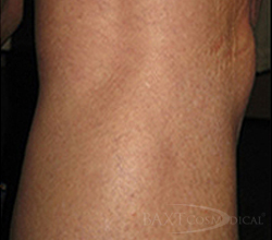 Leg Vein Treatment After - Paramus, NJ Leg Vein Treatment After - Paramus, NJ