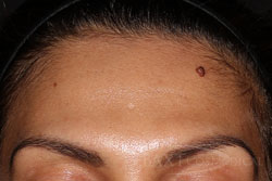 Mole Removal Before - Paramus, NJ