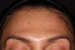 Mole Removal After - Paramus, NJ Mole Removal After - Paramus, NJ