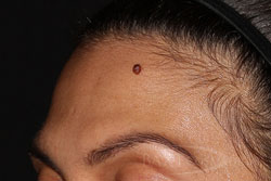 Mole Removal Before - Paramus, NJ