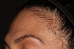 Mole Removal After - Paramus, NJ Mole Removal After - Paramus, NJ